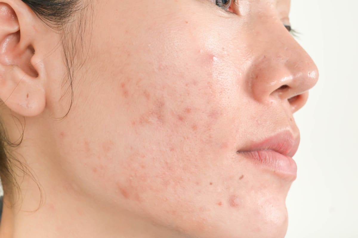 treat acne with cbd